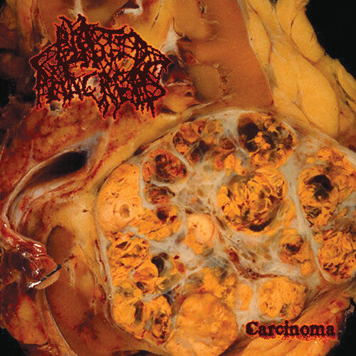 Blasted Pancreas: Carcinoma