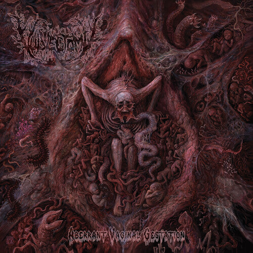 Vulvectomy: Aberrant Vaginal Gestation